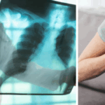 autoridades-de-salud-del-valle-del-cauca-piden-estar-alerta-a-los-sintomas-de-la-tuberculosis:-en-la-region-se-han-registrado-mas-de-700-casos