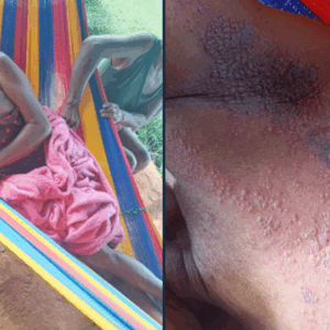 indigenas-de-la-etnia-sanema-en-peligro-por-falta-de-atencion-medica-en-el-alto-caura