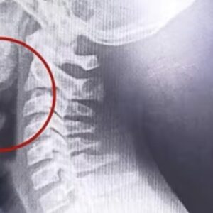 comio-una-galletita-de-agua-y-comenzo-a-escupir-sangre:-el-sorprendente-hallazgo-que-hicieron-los-medicos.