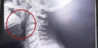 Comió una galletita de agua y comenzó a escupir sangre: el sorprendente hallazgo que hicieron los médicos. comio-una-galletita-de-agua-y-comenzo-a-escupir-sangre:-el-sorprendente-hallazgo-que-hicieron-los-medicos.