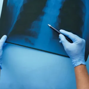 tuberculosis:-como-se-contagia,-cuales-son-sus-sintomas-y-cuando-consultar-tras-un-caso-confirmado