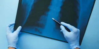 Tuberculosis: Cómo se contagia, cuáles son sus síntomas y cuándo consultar tras un caso confirmado tuberculosis:-como-se-contagia,-cuales-son-sus-sintomas-y-cuando-consultar-tras-un-caso-confirmado