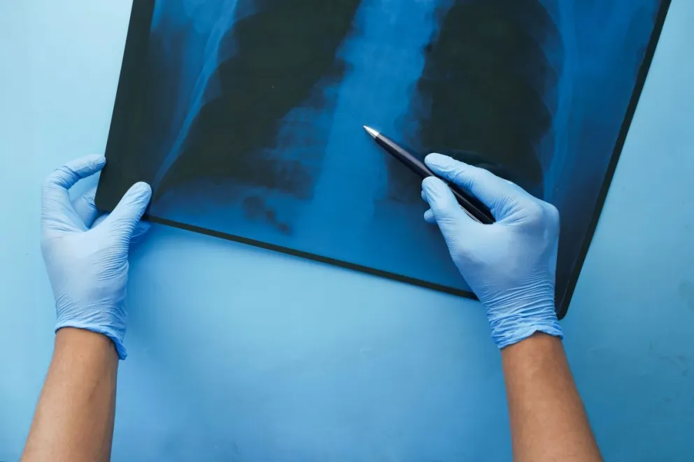 tuberculosis:-como-se-contagia,-cuales-son-sus-sintomas-y-cuando-consultar-tras-un-caso-confirmado